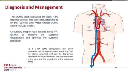 Circulatory support withV-PaA ECMO in a patient with acute right ventricular failure and refractory hypoxemia secondary to diffuse alveolar haemorrhage due to granulomatosis with polyangiitis