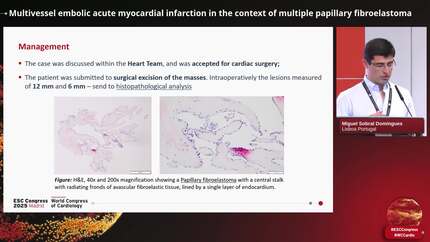 Multivessel embolic acute myocardial infarction in the context of multiple papillary fibroelastoma
