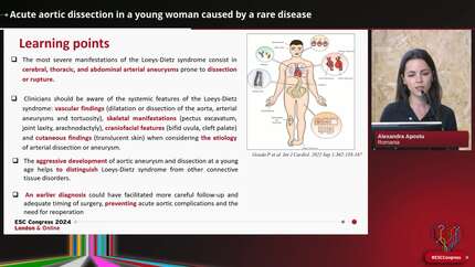 Acute aortic dissection in a young woman caused by a rare disease