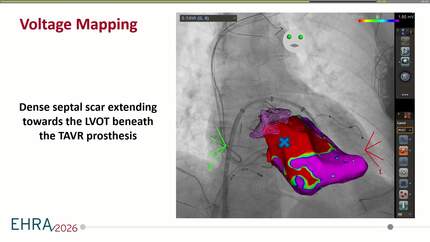 Complex ventricular ablations