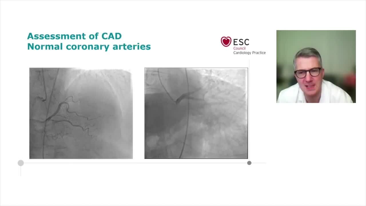 Aortic stenosis treatment options - which therapy for which patient?