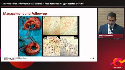 Chronic coronary syndrome as an initial manifestation of IgG4-related aortitis.