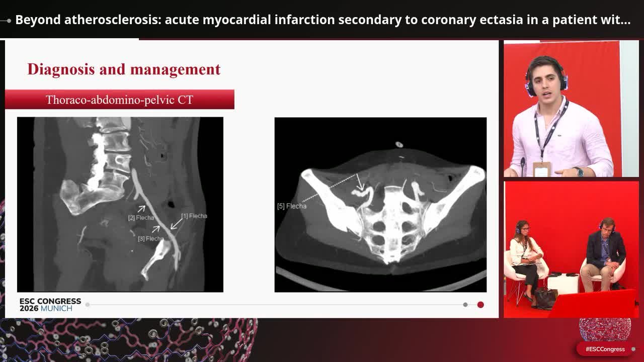 Beyond plaque rupture: rare causes of ST-elevation myocardial infarction
