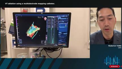 VT ablation using a multielectrode mapping catheter.