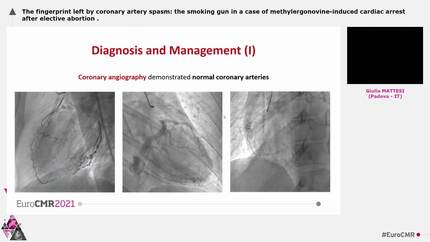 The fingerprint left by coronary artery spasm: the smoking gun in a case of methylergonovine-induced cardiac arrest after elective abortion
.