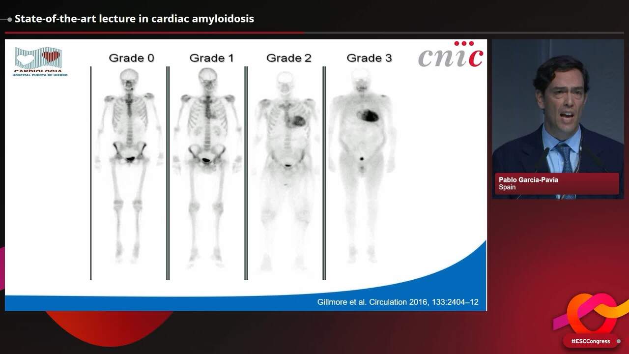 State-of-the-art lecture in cardiac amyloidosis