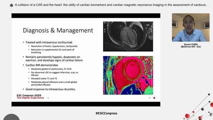 A collision of a CAR and the heart: the utility of cardiac biomarkers and cardiac magnetic resonance imaging in the assessment of cardiovascular toxicity due to chimeric antigen receptor T-cell cancer therapy.