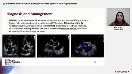 Pacemaker lead-induced tricuspid severe stenosis and regurgitation.