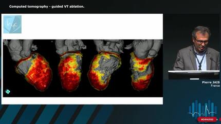 The role of imaging in ventricular tachycardia (VT) ablation
