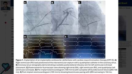 Femoral access-guided multi-site ICD implantation: a single-center experience in 903 cases from northeast brazil