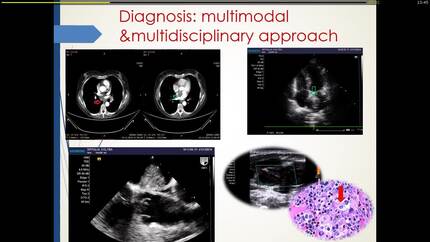 Mediastinal masses and a left atrial tumor: are they related? -the role of multimodal imaging in the diagnosis and the management of the patient