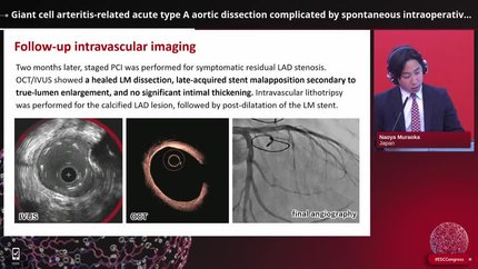 Giant cell arteritis-related acute type A aortic dissection complicated by spontaneous intraoperative left main coronary malperfusion successfully treated with percutaneous coronary intervention