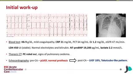 Silent saboteur: a tale of nearly fatal intermittent prosthetic valve dysfunction