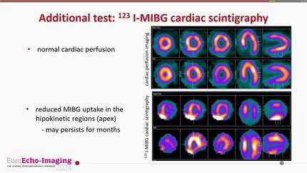 Acute coronary syndrome
