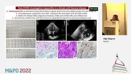 COVID-19 IN PATIENTS WITH DIFFERENT CARDIOMYOPATHIES: COURSE AND OUTCOME, ROLE OF VERIFIED POST-COVID MYOCARDITIS
