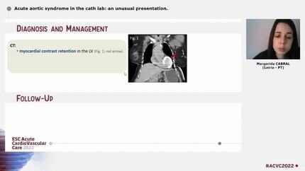 Acute aortic syndrome in the cath lab: an unusual presentation.