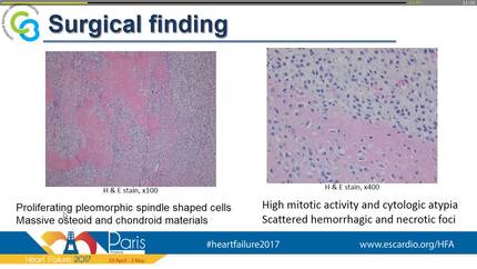 Primary cardiac osteosarcoma