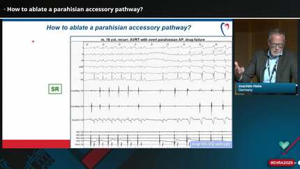 How to approach challenging supraventricular targets