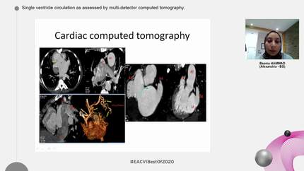 Single ventricle circulation as assessed by multi-detector computed tomography.