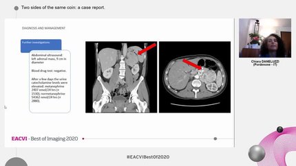 Two sides of the same coin: a case report.