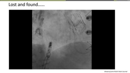 Extraction of a dislodged leadless pacemaker from the left pulmonary artery