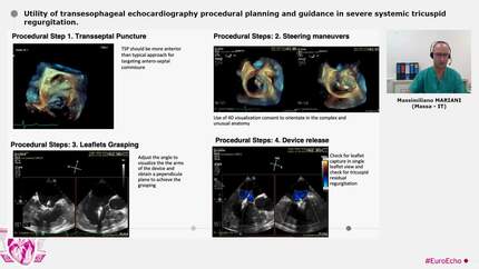 Utility of transesophageal echocardiography procedural planning and guidance in severe systemic tricuspid regurgitation.