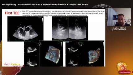 Disappearing LAA thrombus with a LA myxoma coincidence - a clinical case study.