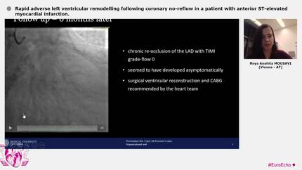 Rapid adverse left ventricular remodelling following coronary no-reflow in a patient with anterior ST-elevated myocardial infarction.