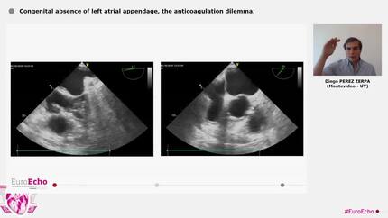 Congenital absence of left atrial appendage, the anticoagulation dilemma.