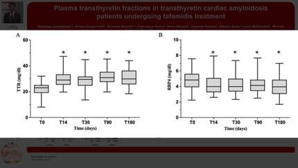 Plasma transthyretin fractions in transthyretin cardiac amyloidosis patients undergoing tafamidis treatment