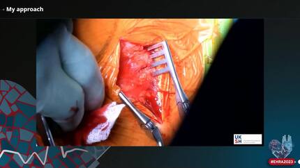 Live-in-the-Box: lead extraction