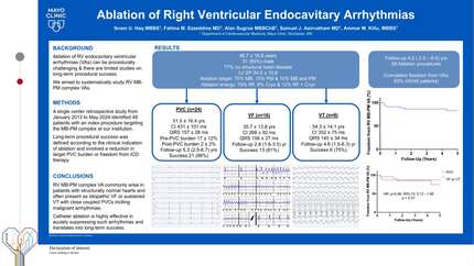 Ablation of right ventricular endocavitary arrhythmias 