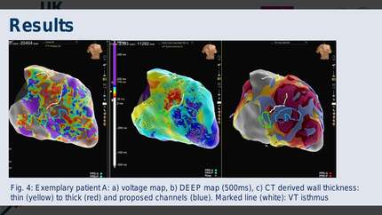 A novel multilayer anatomical constraint algorithm for channel detection from computed tomography to  guide catheter ablation of ventricular tachycardia