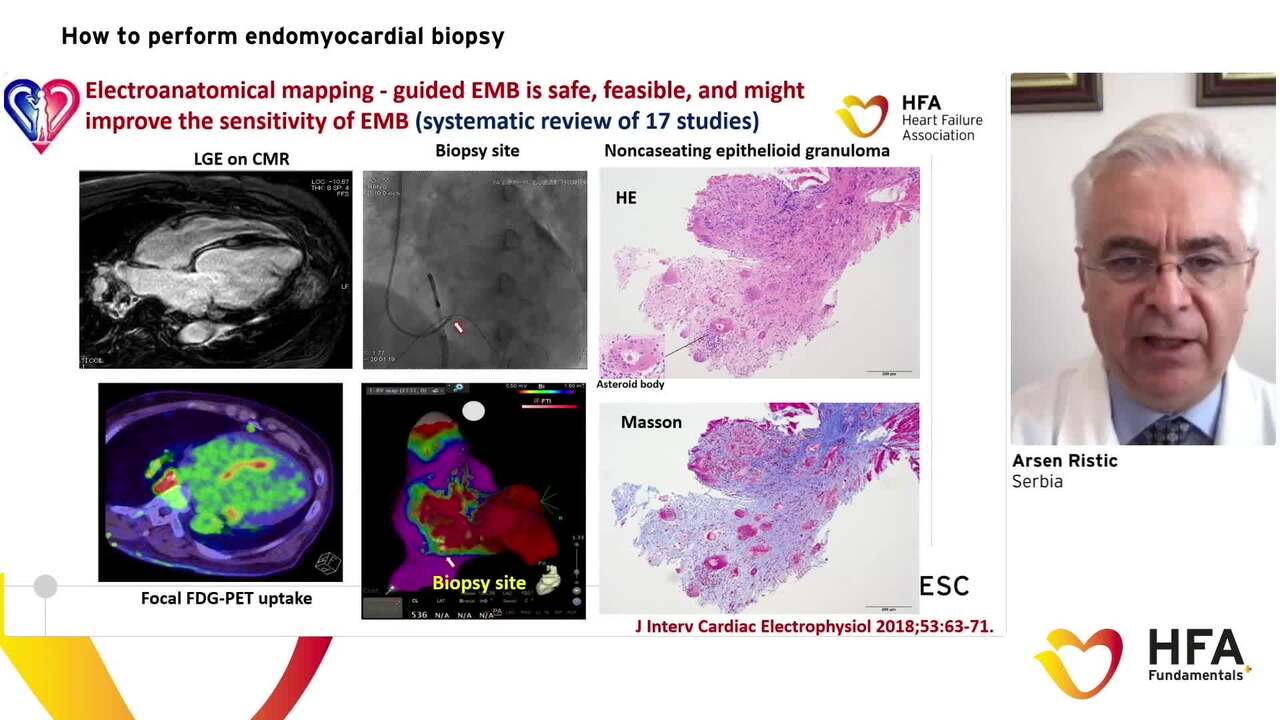 HFA Fundamentals+ How to: Perform endomyocardial biopsy
