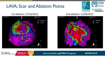 Are recurrences of post MI VT due to substrate progression of insufficient index ablation? A 4 years FU study