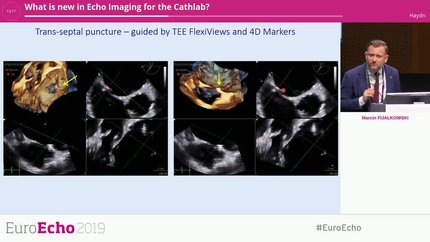 What is new in Echo Imaging for the Cathlab?
