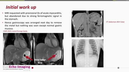 Heads and tails and a case of vaccine-associated myocarditis