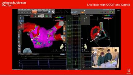 Choose the right workflow for your AF patients - Live cases with Varipulse, QDOT and Optrell 