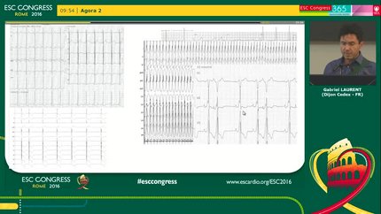 High prevalence of arrhythmic and haemodynamic complications in patients with cardiac glycogenosis secondary to PRKAG2 mutations