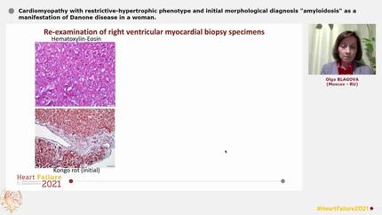 Cardiomyopathy with restrictive-hypertrophic phenotype and initial morphological diagnosis "amyloidosis" as a manifestation of Danone disease in a woman.