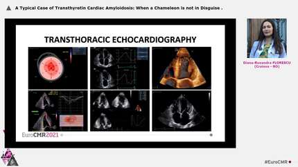 A Typical Case of Transthyretin Cardiac Amyloidosis: When a Chameleon is not in Disguise
.