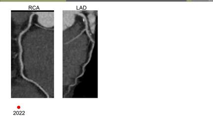 Case 2: a 55-year-old woman, borderline 10-year ASCVD risk, hesitant about lifelong statins.