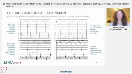 Atrio-ventricular reentry tachycardia, without involvement of the AV node  dual accessory pathway in young, otherwise healthy patient.
