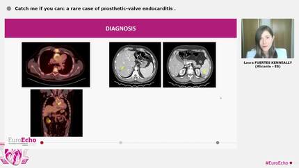 Catch me if you can: a rare case of prosthetic-valve endocarditis
.