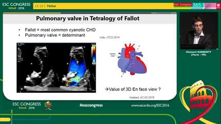 3D echo in congenital heart disease 