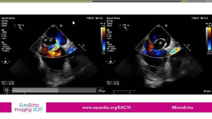 Invasive Cardiology and TOE, a permanent relationship.