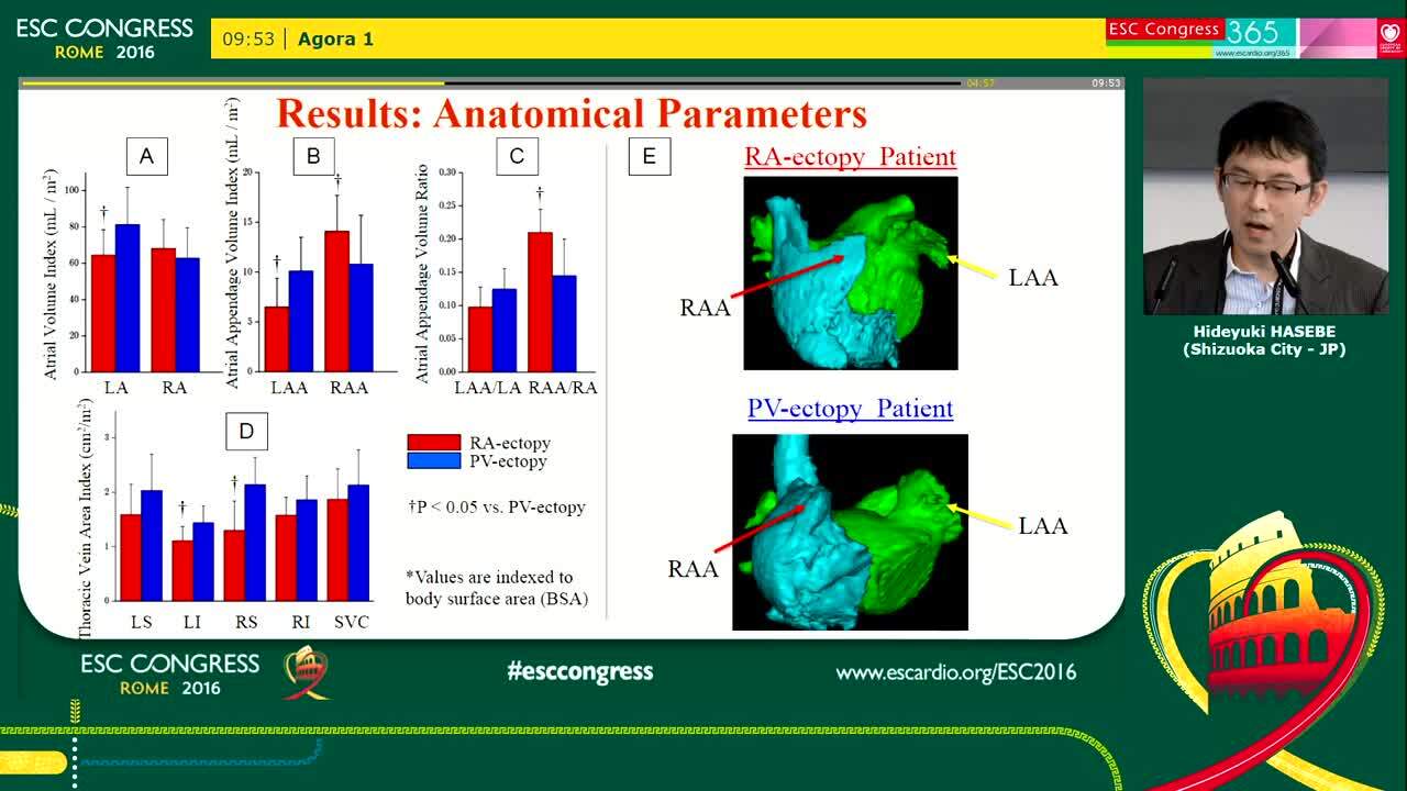 Biatrial structural characteristics and association with epicardial adipose tissue in patients with paroxysmal atrial fibrillation initiated by right atrial ectopy