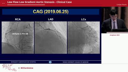 Low Flow Low Gradient Aortic Stenosis - Clinical Case