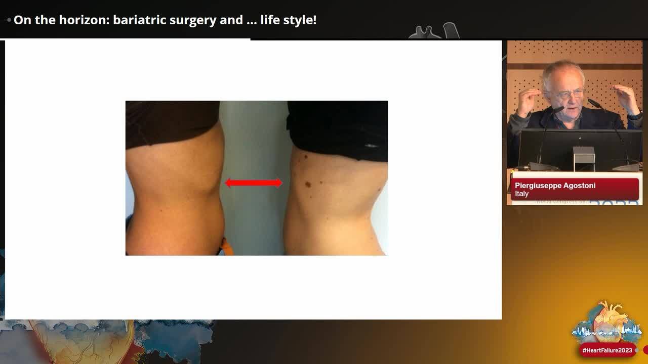 On the horizon: bariatric surgery and … life style!