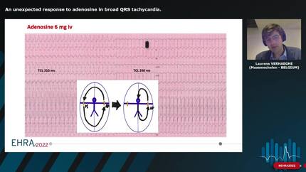 An unexpected response to adenosine in broad QRS tachycardia.